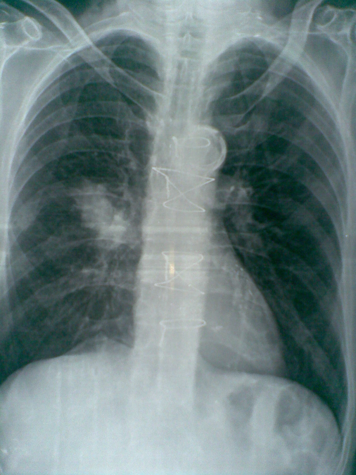 Cabg Chest X Ray vrogue.co